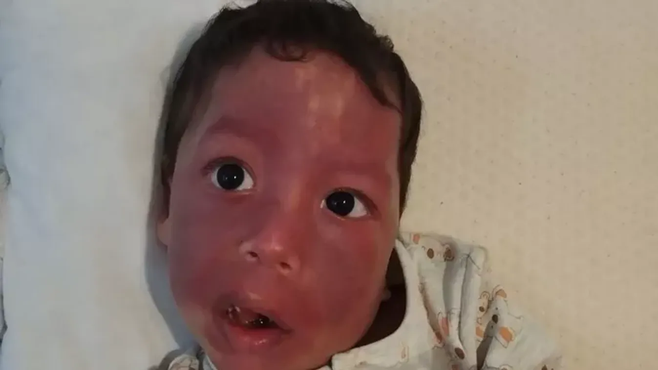 Halálos epilepszia ellen küzd az 5 éves Ábel