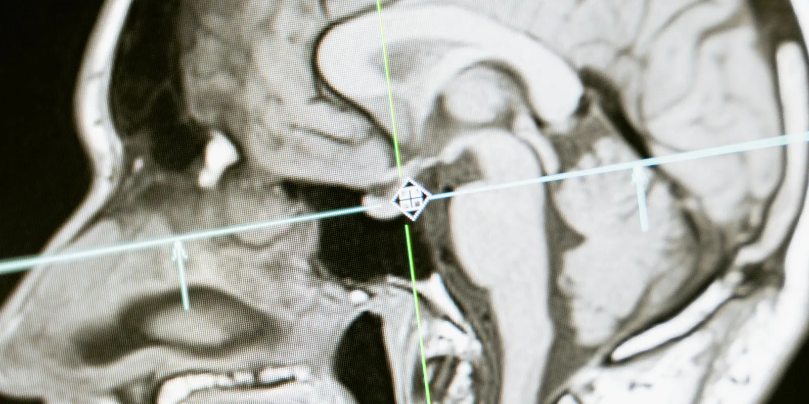 A fiatal demencia beteg agya 70 éves kori állapotban volt