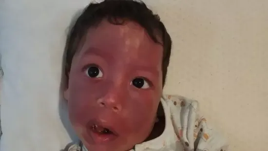 „Nincs kiút, teljesen kétségbe vagyok esve” - Ábel küzdelme a Sturge–Weber-szindrómával