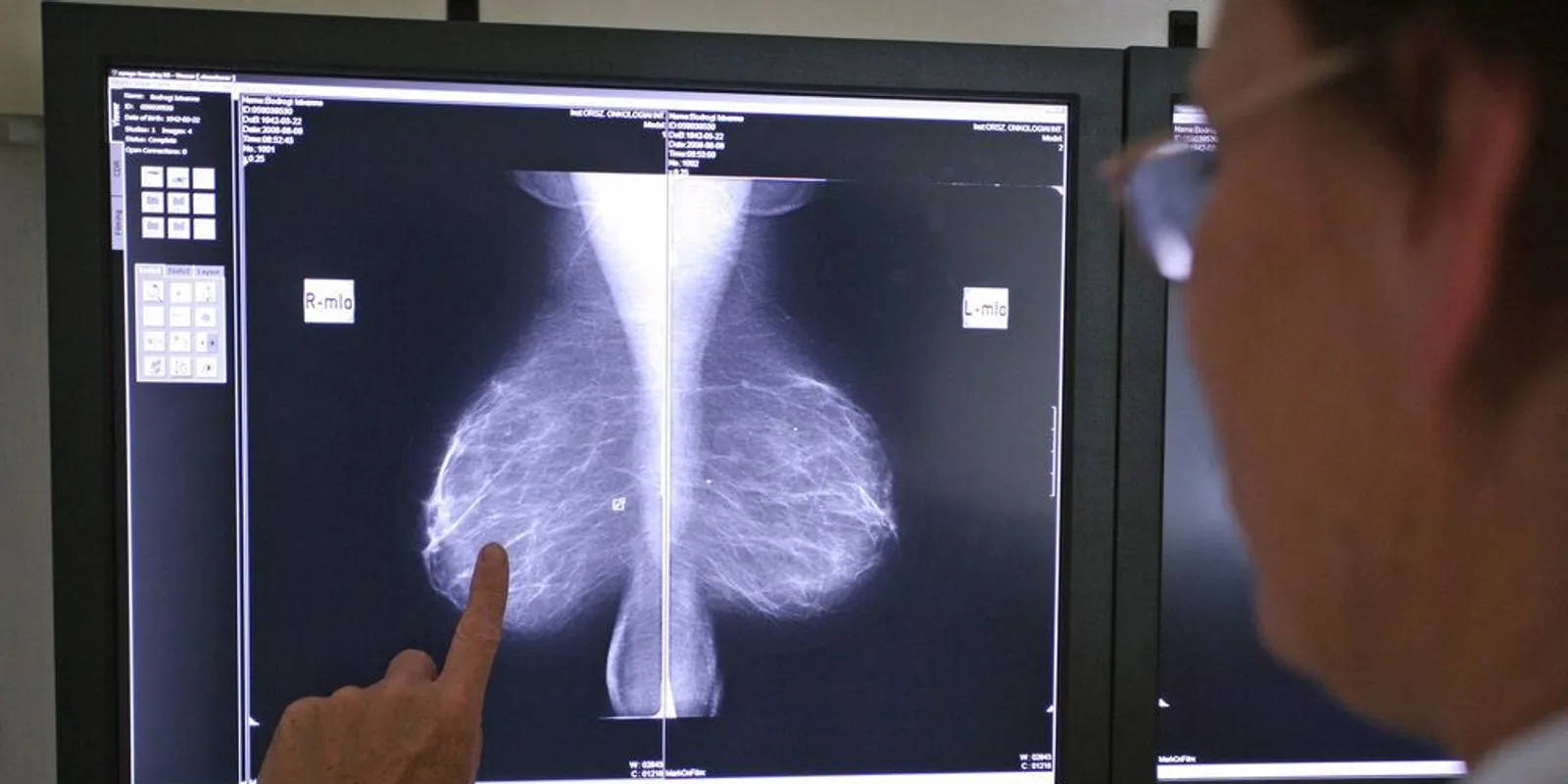 Kinek és milyen rákszűrésen ajánlott részt vennie? Mutatjuk!