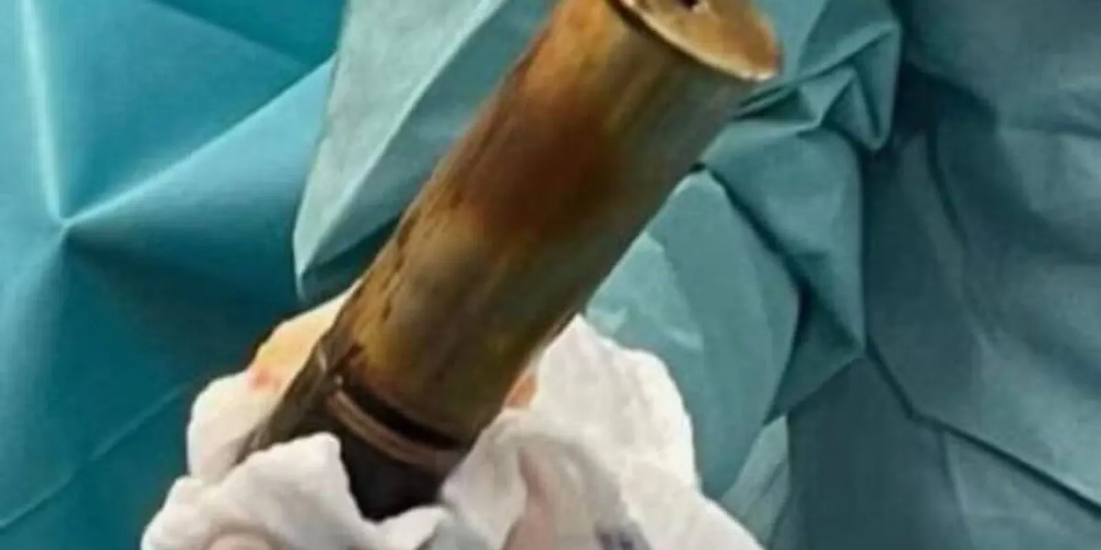 Fájt a hasa, tüzérségi lőszert találtak a végbelében