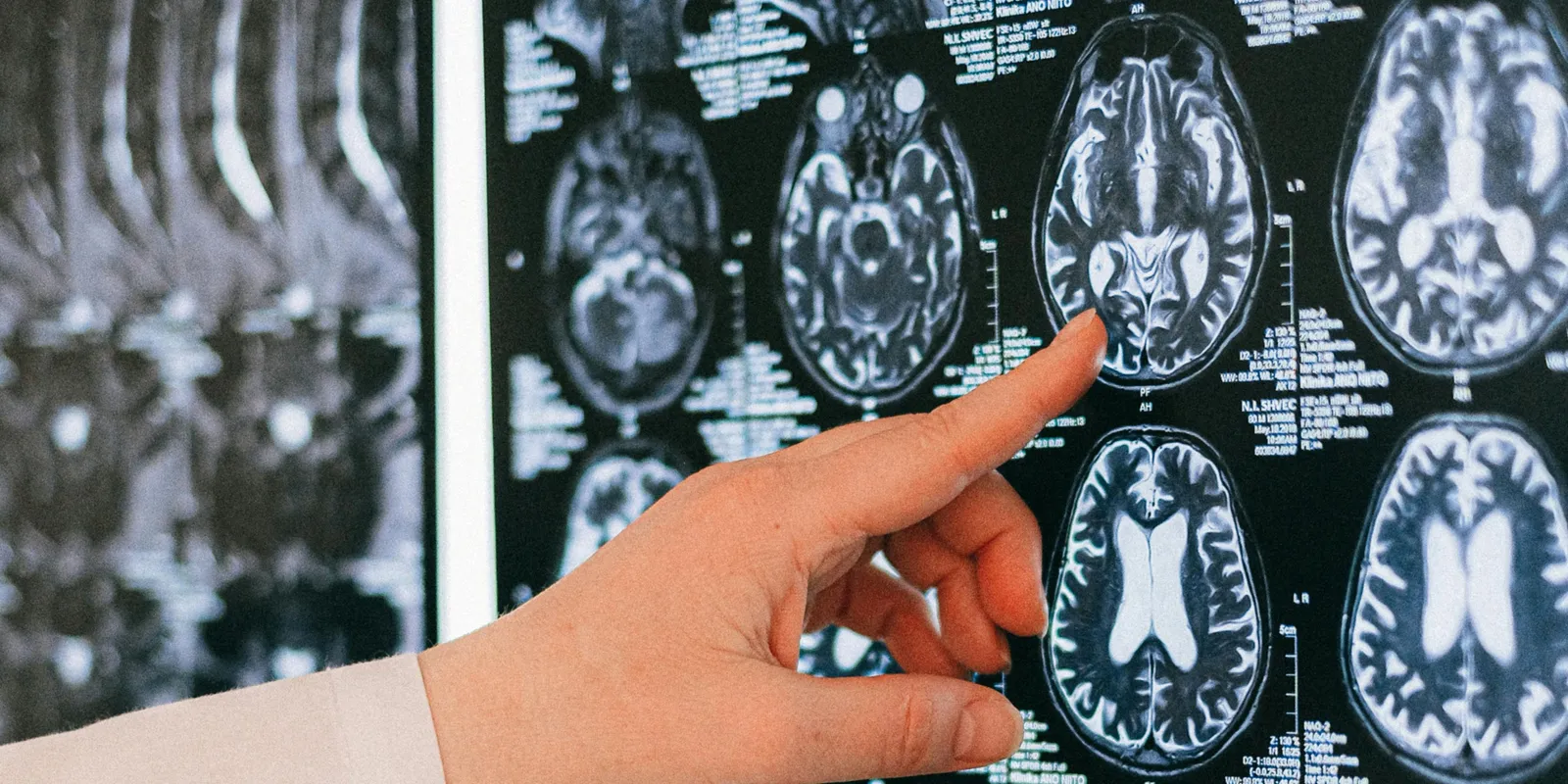 Ezekkel a módszerekkel tudod elkerülni a demenciát