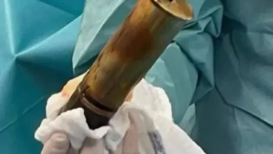 Franciaország: kórházba ment fájó hassal, tüzérségi lőszert találtak a végbelében