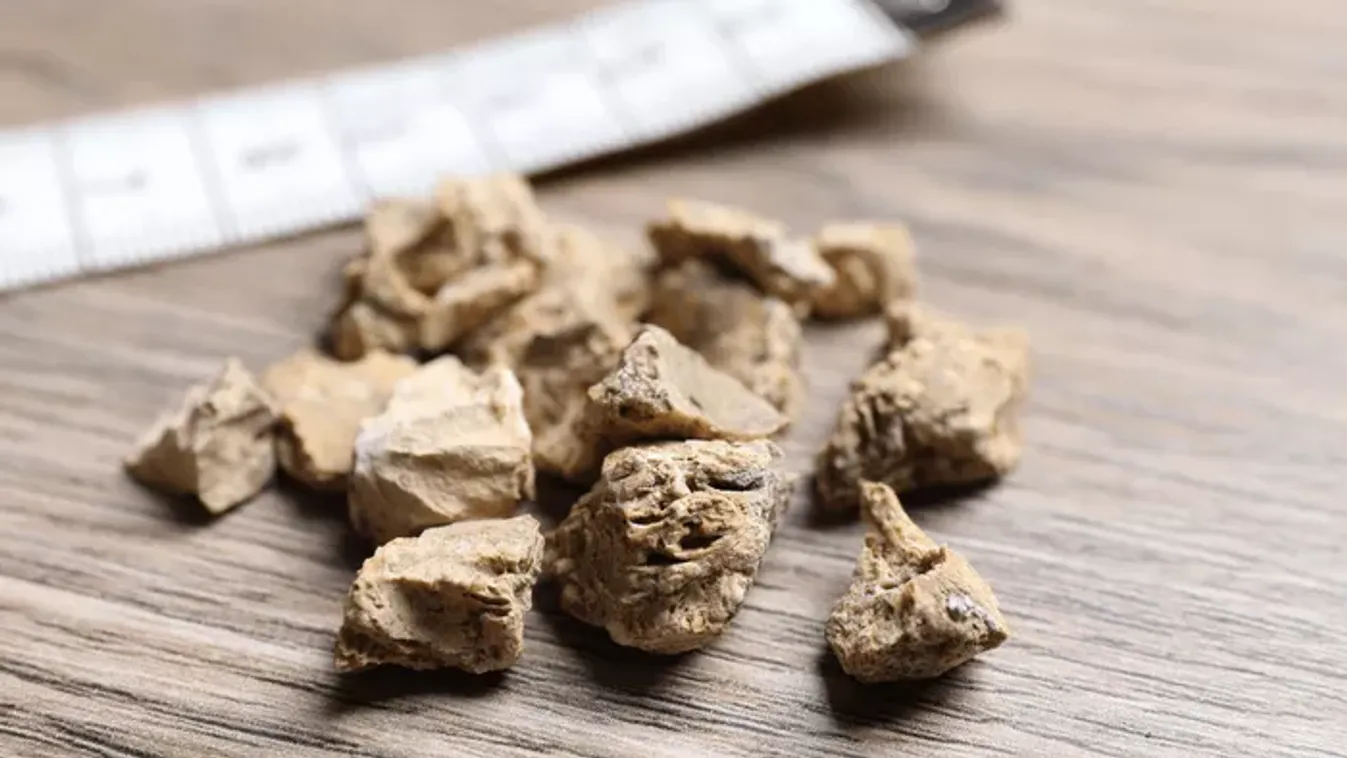 Drágakőnek hitték, de veseköveket loptak el az olasz betörők