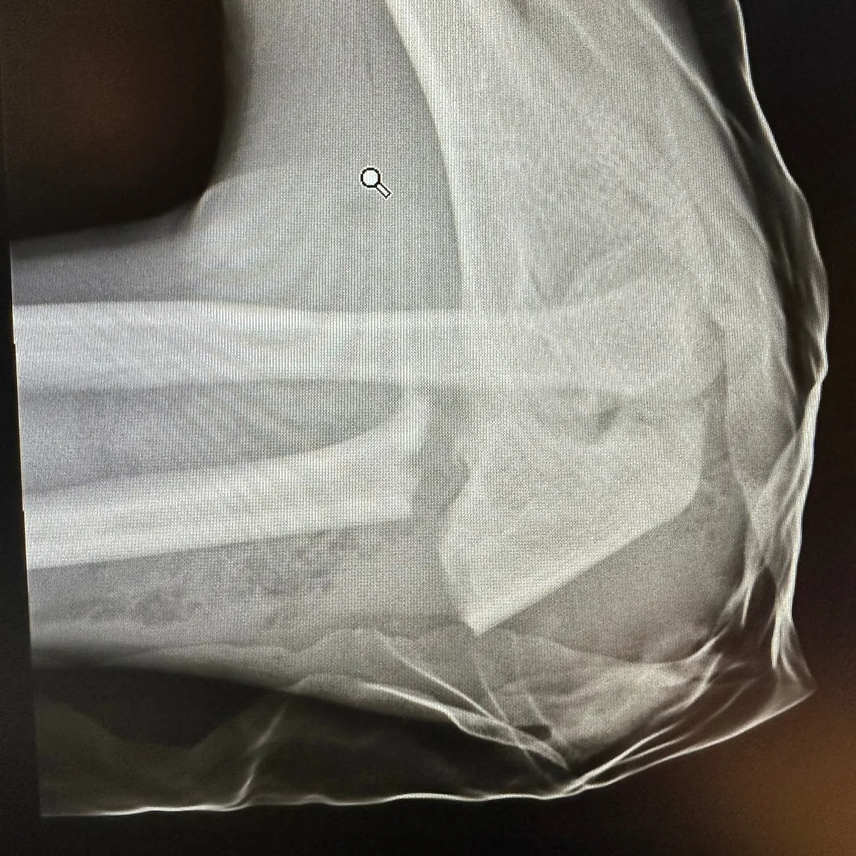 Rollerezés közben tört el egy fiú könyöke. 