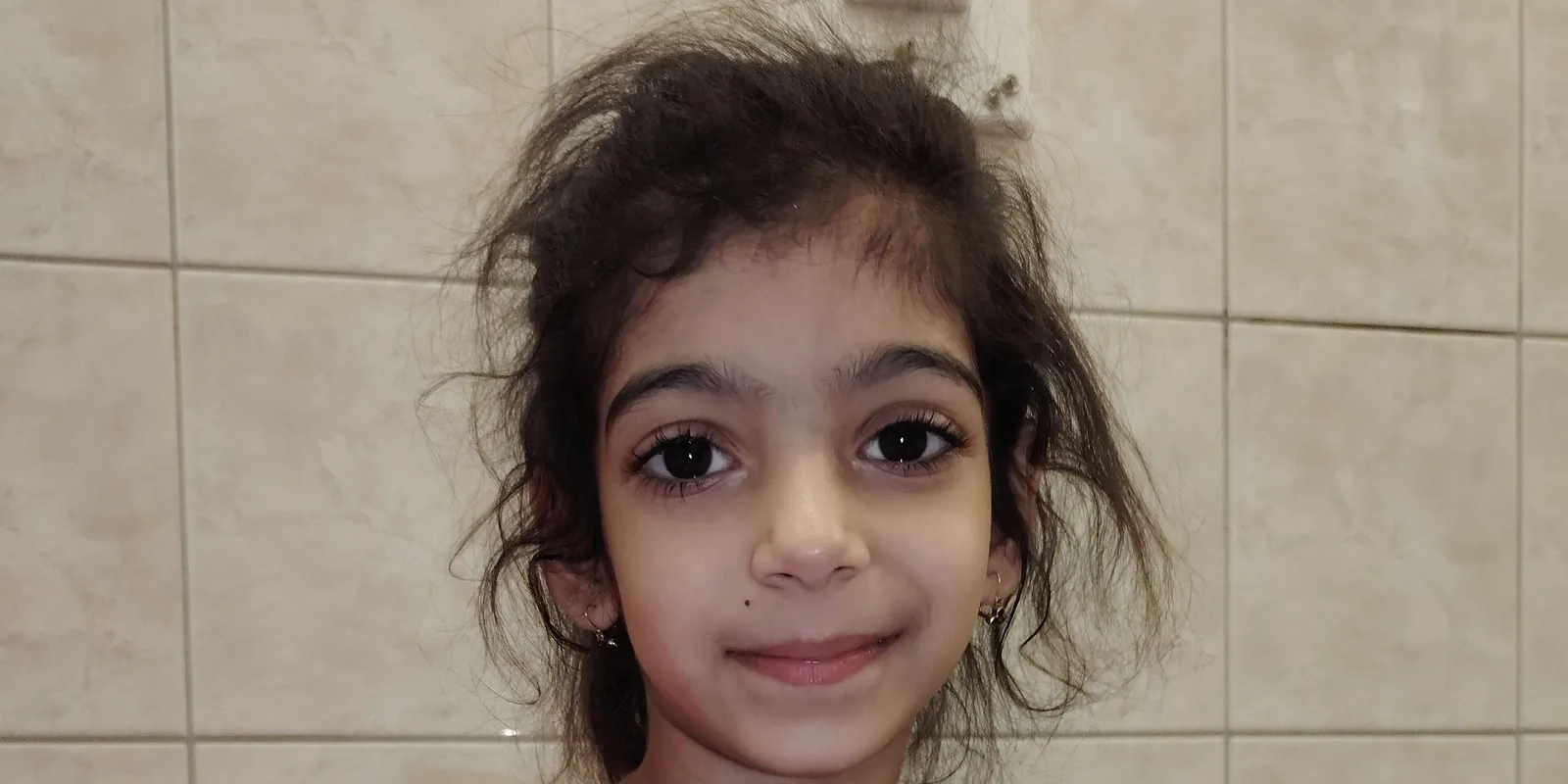 Hatalmas daganatot találtak a kis Bella tüdejében