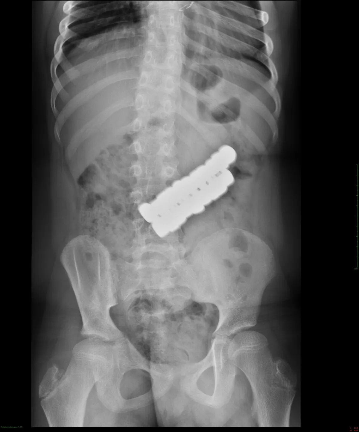 A kisfiú szerencsére megúszta, de műtétre így is sor került a lenyelt mágnesek miatt