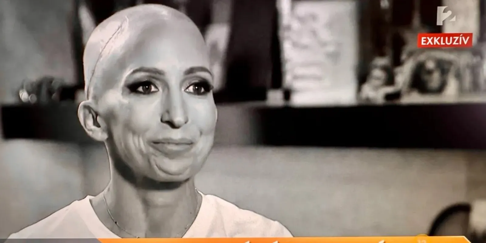 Rubint Réka rákkal küzd, végre kamerák elé áll betegségével