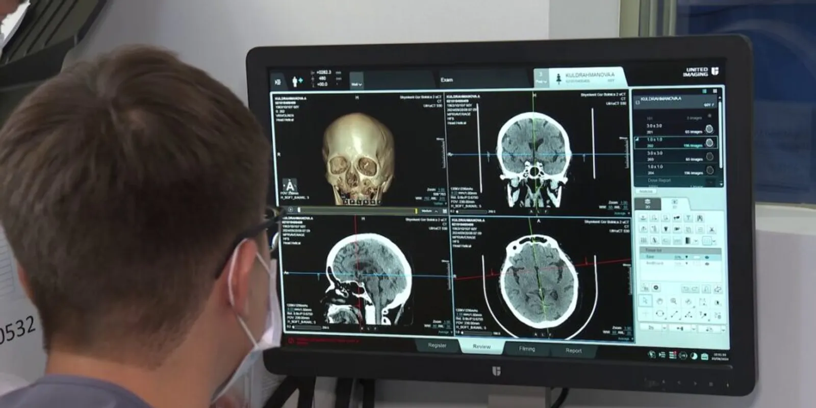 Az AI felére csökkentette az agyvérzés halálozási arányát