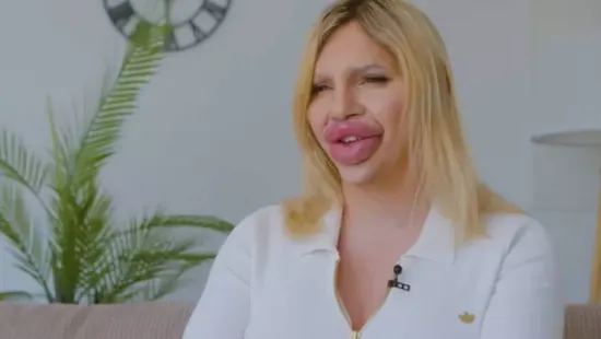 1 liter töltőanyag: "Enyém a világ legnagyobb ajka, de még nagyobbat akarok!"