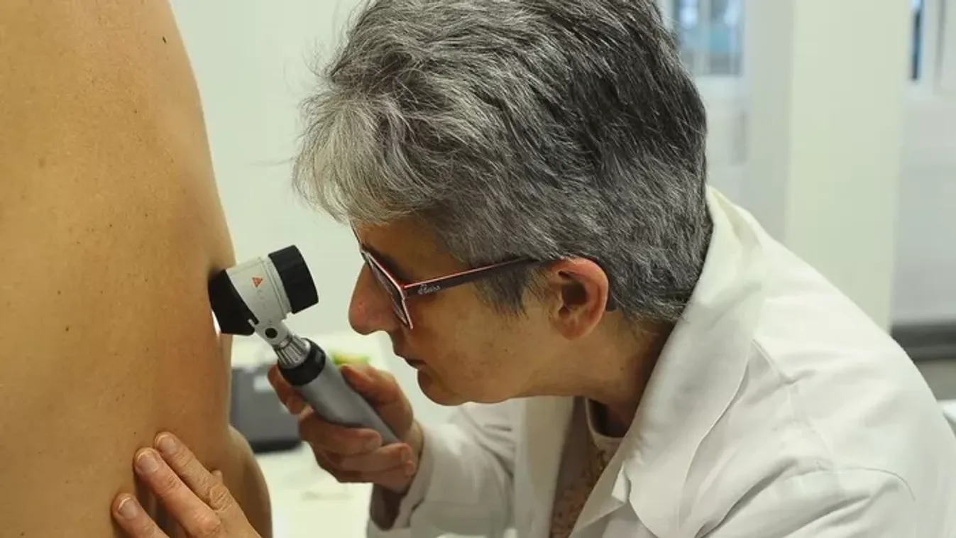 Országos bőrrákszűrési program indult – íme a helyszínek és a tudnivalók