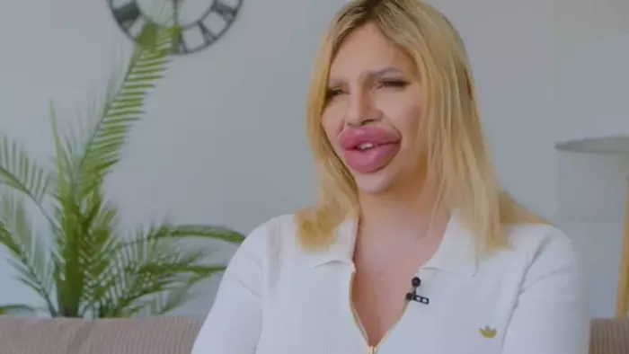 1 liter töltőanyag: "Enyém a világ legnagyobb ajka!"