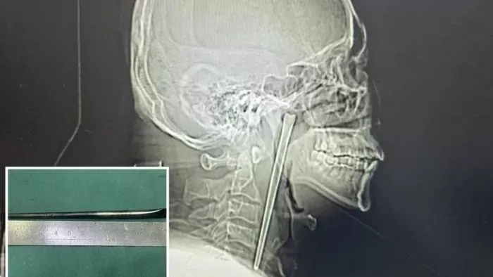 8 évig élt evőpálcikával a torkában egy kínai férfi