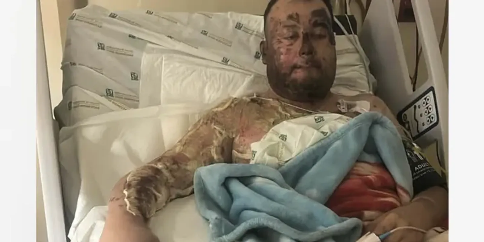 Elvesztette kezét az édesapa egy brutális áramütésben