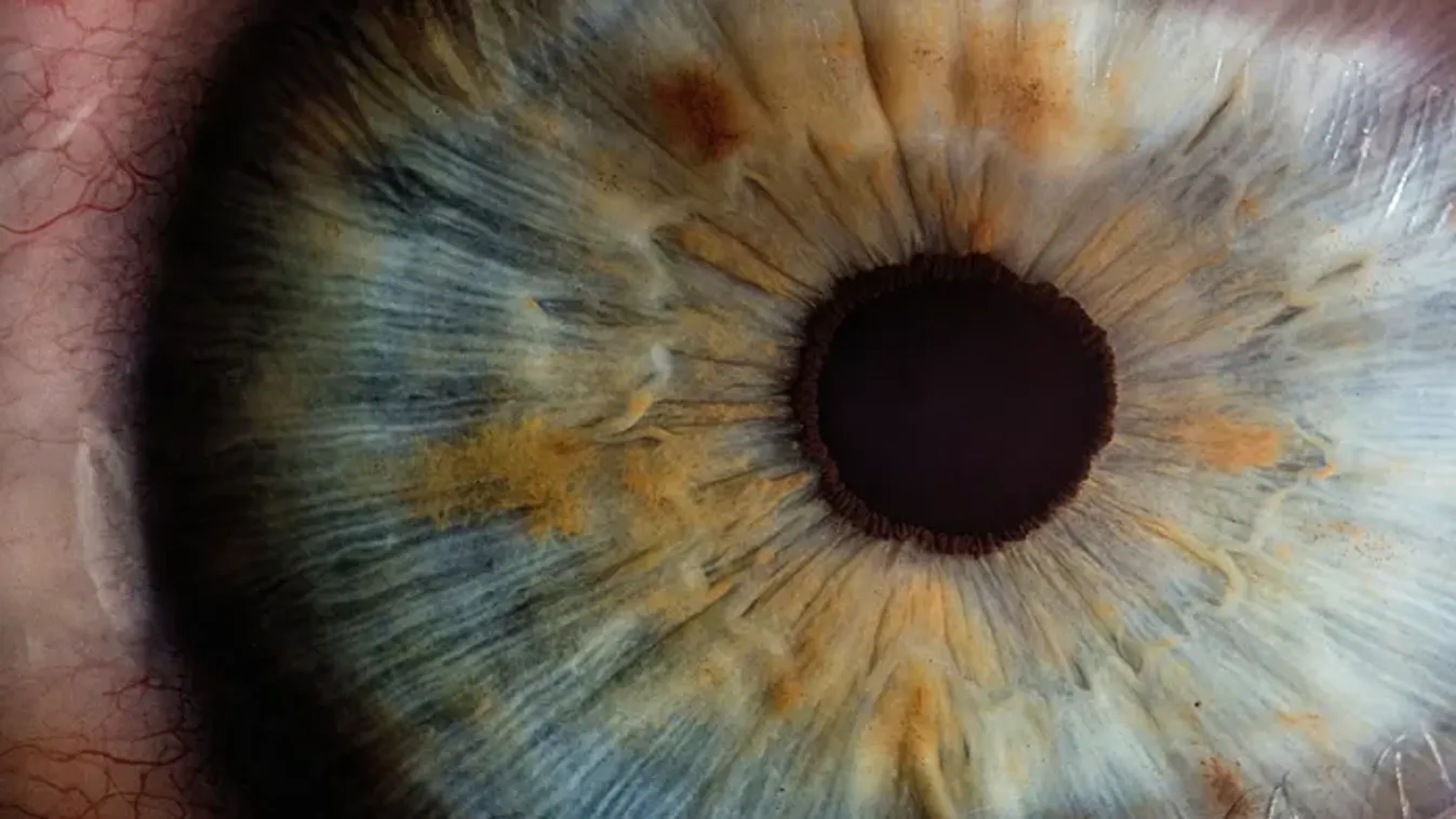 Azt hitte, csak kötőhártya-gyulladás, 36 évesen veszítette el a látását az anyuka