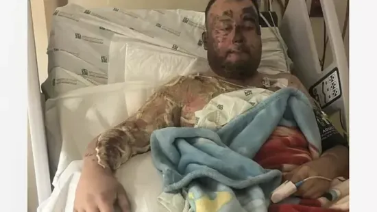 Elvesztette kezét az édesapa egy brutális áramütésben, lánya macskáját akarta megmenteni