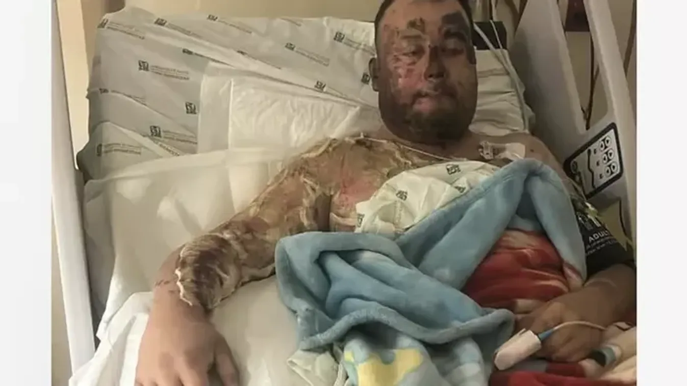 Elvesztette kezét az édesapa egy brutális áramütésben, lánya macskáját akarta megmenteni