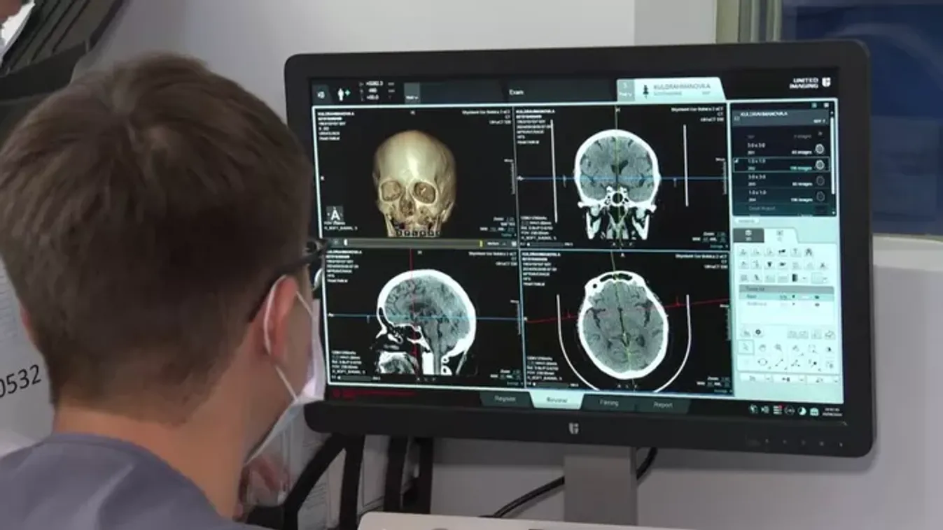Az AI felére csökkentette az agyvérzés halálozási arányát