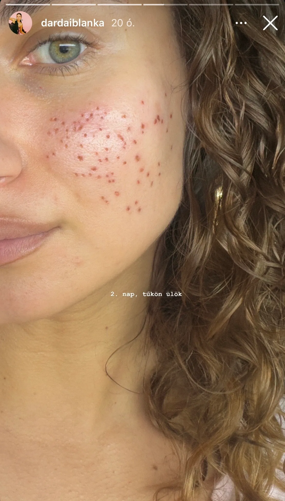 Dárdai Blanka megmutatta a hegeket az arcán