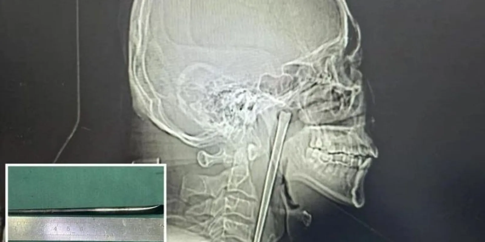 8 évig élt evőpálcikával a torkában egy kínai férfi