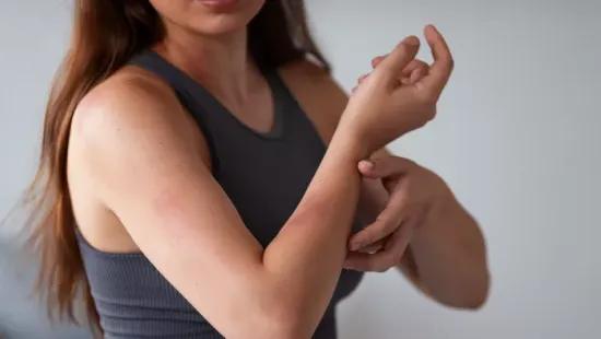 Ritka allergia tartja fogságban: a nőnek a napfény is fájdalmat okoz