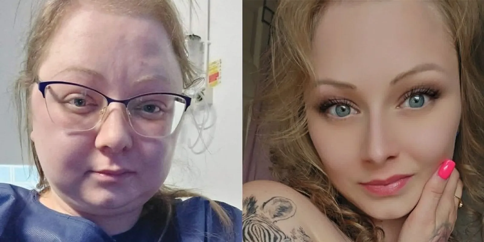 Ritka kór támadta meg a magyar modellt – 56 kilót hízott