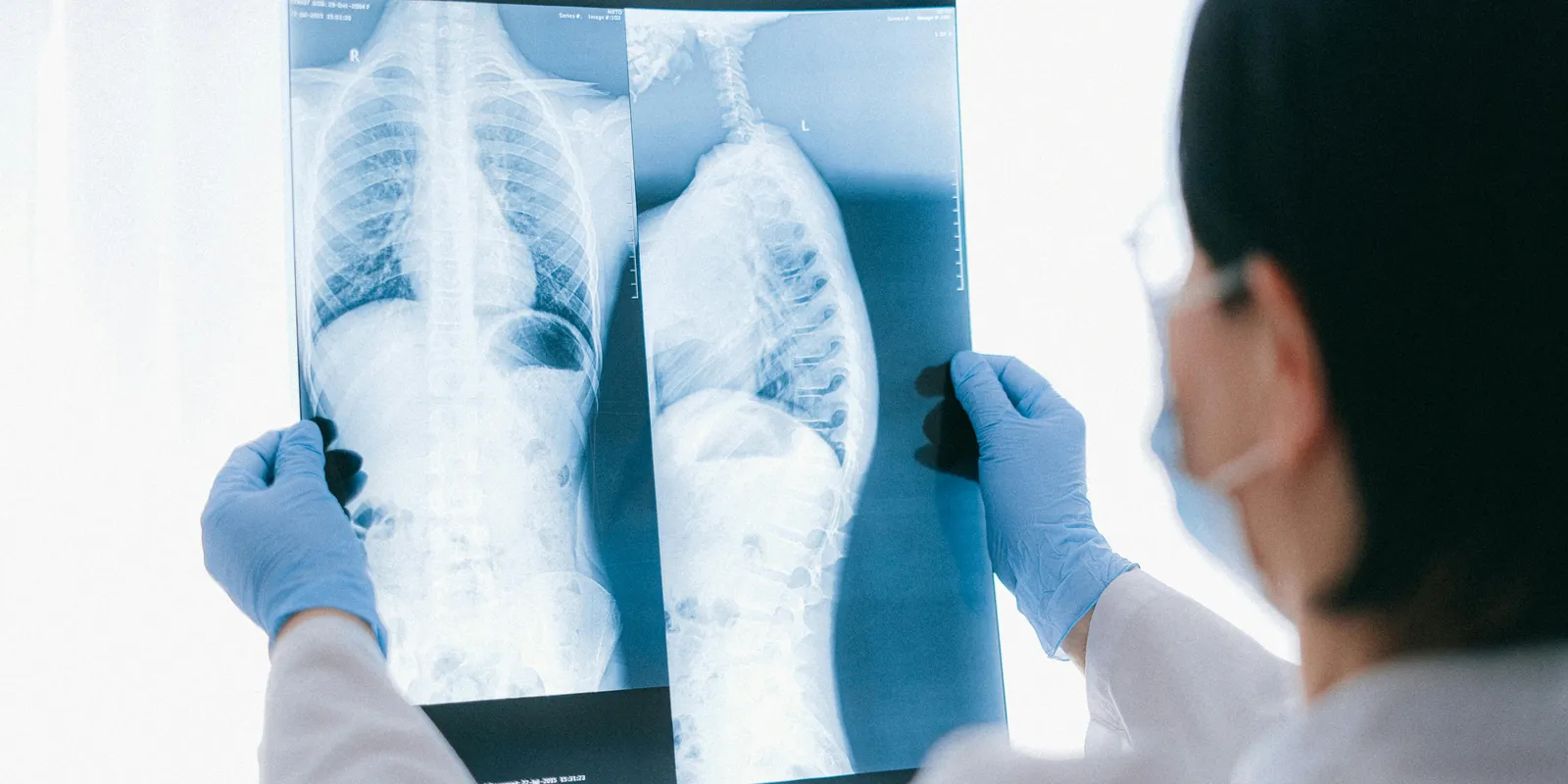 Romlott a hercegné állapota, életmentő műtétre van szüksége